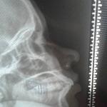 Indian nurse injured in BMC mortar attack